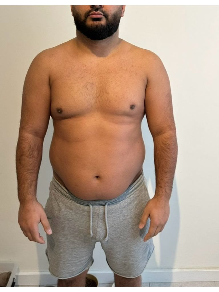 Onbewerkte foto van een cliënt vóór het traject in grijze short