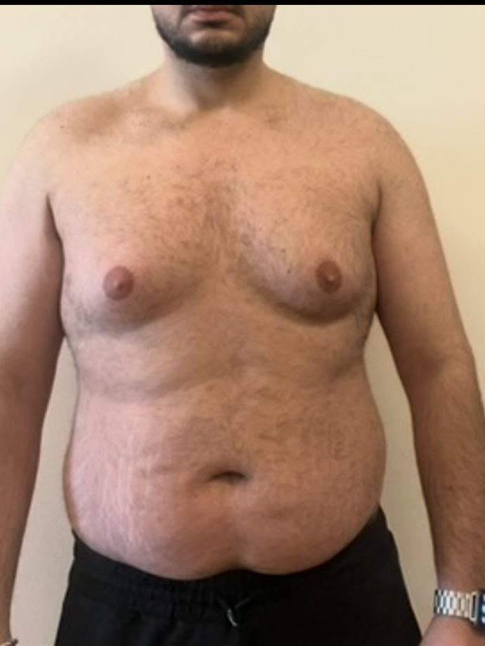 Onbewerkte foto van een cliënt vóór het traject
